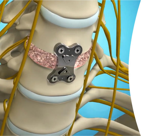 Illustration of cervical fusion implants supporting the neck vertebrae
