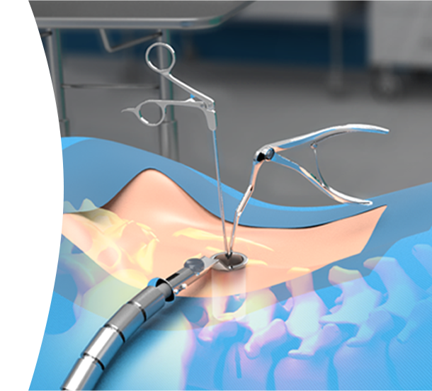 Illustration of a minimally invasive surgical access corridor